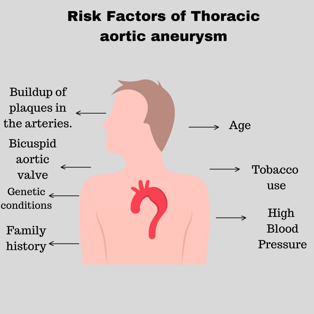 Risk Factors of Thoracic aortic aneurysm